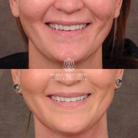 Beverly Hills Center Female Patient Before and After CUPID LIFT® Lip Lift