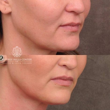 Beverly Hills Center Female Patient Before and After CUPID LIFT® Lip Lift