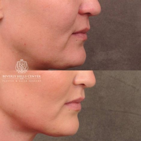 Beverly Hills Center Female Patient Before and After CUPID LIFT® Lip Lift