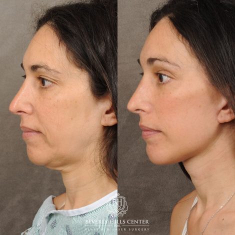 Beverly Hills Center Female Patient Before and After Auralyft, Chin Implant, Brow Lift, CUPID LIFT® Lip Lift