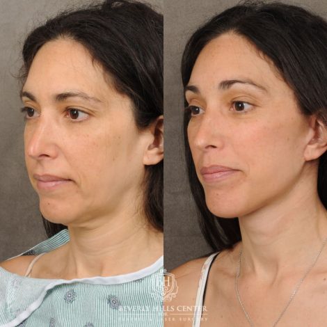 Beverly Hills Center Female Patient Before and After Auralyft, Chin Implant, Brow Lift, CUPID LIFT® Lip Lift