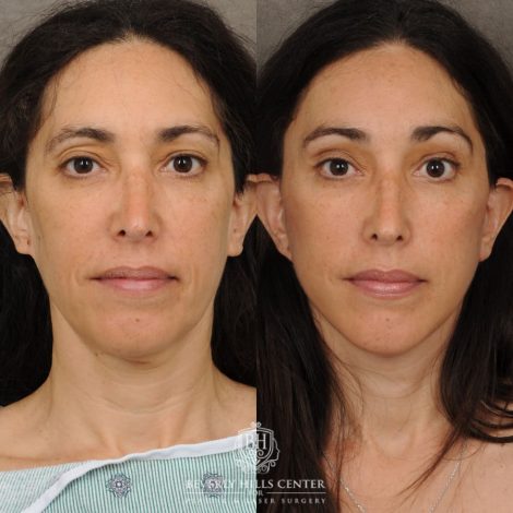 Beverly Hills Center Female Patient Before and After Auralyft, Chin Implant, Brow Lift, CUPID LIFT® Lip Lift