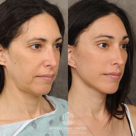 Beverly Hills Center Female Patient Before and After Auralyft, Chin Implant, Brow Lift, CUPID LIFT® Lip Lift