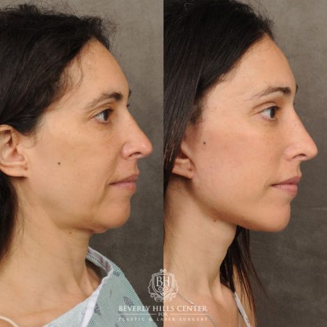 Beverly Hills Center Female Patient Before and After Auralyft, Chin Implant, Brow Lift, CUPID LIFT® Lip Lift