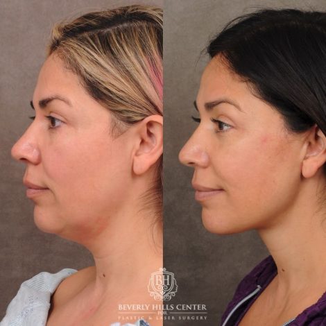 Beverly Hills Center Female Patient Before and After Auralyft, Brow Lift, Upper Blepharoplasty