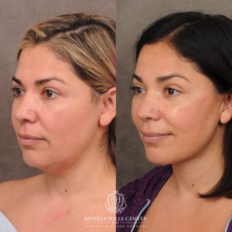 Beverly Hills Center Female Patient Before and After Auralyft, Brow Lift, Upper Blepharoplasty