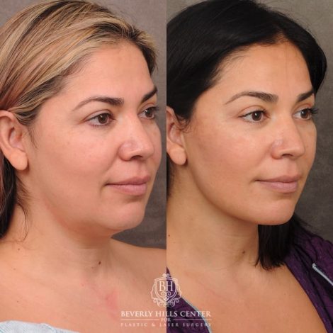 Beverly Hills Center Female Patient Before and After Auralyft, Brow Lift, Upper Blepharoplasty