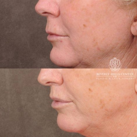 Beverly Hills Center Female Patient Before and After CUPID LIFT® Corner Lift