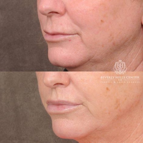 Beverly Hills Center Female Patient Before and After CUPID LIFT® Corner Lift