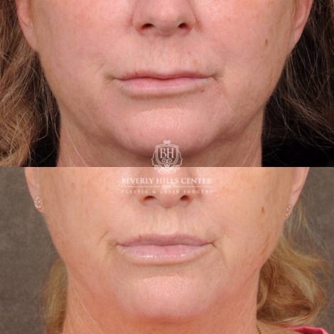 Beverly Hills Center Female Patient Before and After CUPID LIFT® Corner Lift