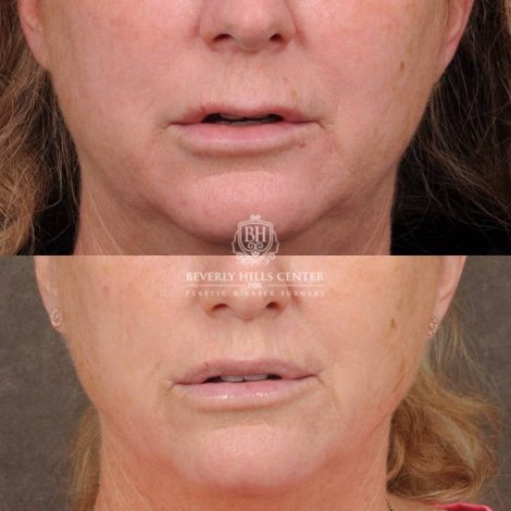 Beverly Hills Center Female Patient Before and After CUPID LIFT® Corner Lift