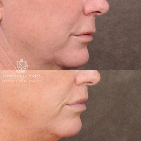 Beverly Hills Center Female Patient Before and After CUPID LIFT® Corner Lift