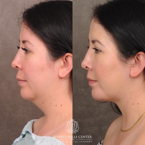 Beverly Hills Center Female Patient Before and After CUPID LIFT® Lip Lift & Weekend Necklift