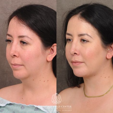 Beverly Hills Center Female Patient Before and After CUPID LIFT® Lip Lift & Weekend Necklift