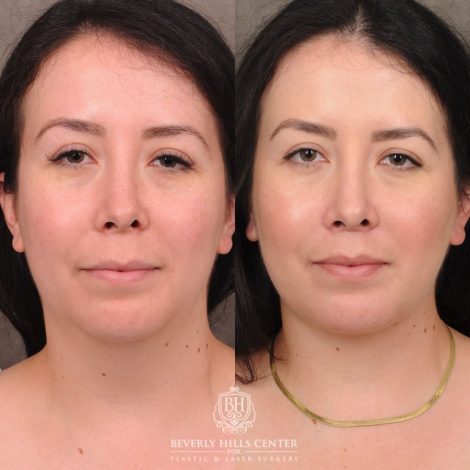Beverly Hills Center Female Patient Before and After CUPID LIFT® Lip Lift & Weekend Necklift