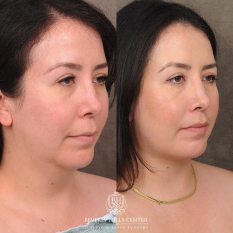 Beverly Hills Center Female Patient Before and After CUPID LIFT® Lip Lift & Weekend Necklift