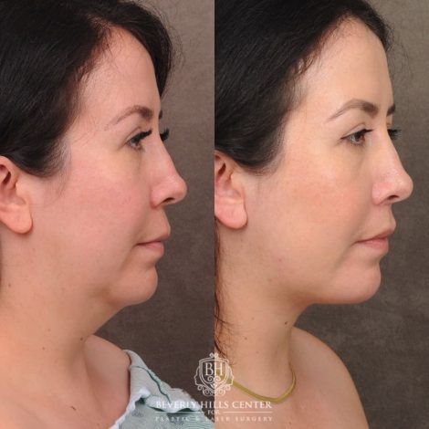 Beverly Hills Center Female Patient Before and After CUPID LIFT® Lip Lift & Weekend Necklift