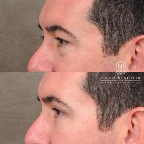 Beverly Hills Center Female Patient Before and After Upper & Lower Blepharoplasty