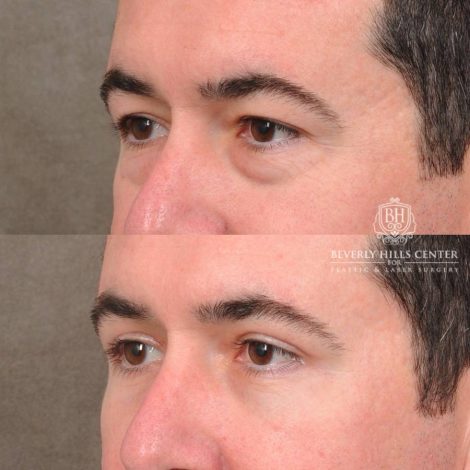 Beverly Hills Center Female Patient Before and After Upper & Lower Blepharoplasty