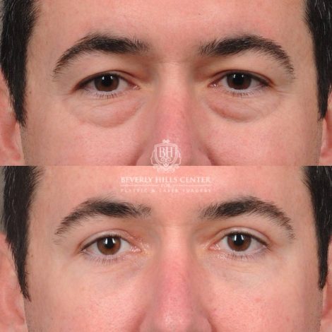 Beverly Hills Center Female Patient Before and After Upper & Lower Blepharoplasty