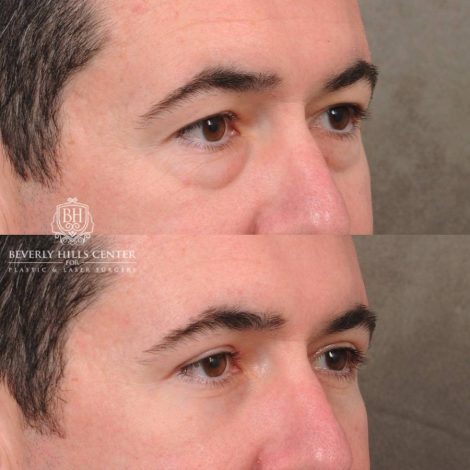 Beverly Hills Center Female Patient Before and After Upper & Lower Blepharoplasty