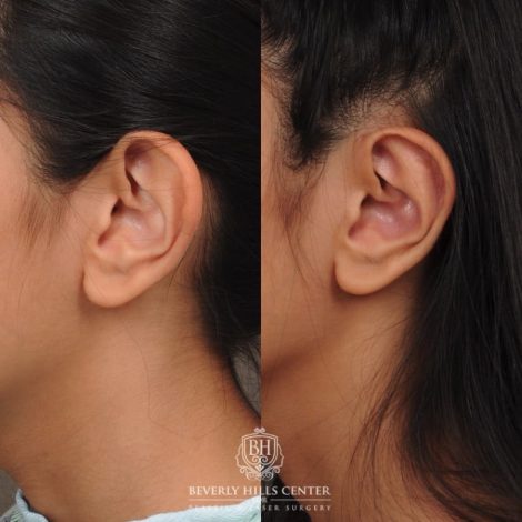 Beverly Hills Center Female Patient Before and After Otoplasty