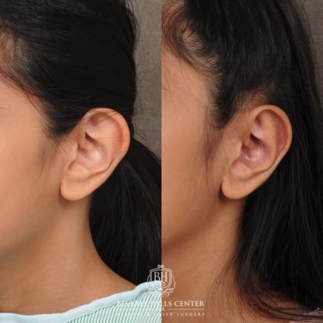 Beverly Hills Center Female Patient Before and After Otoplasty