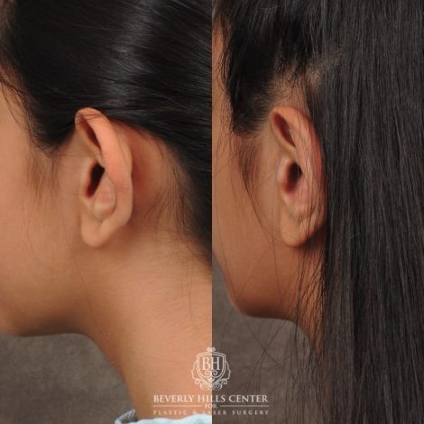 Beverly Hills Center Female Patient Before and After Otoplasty