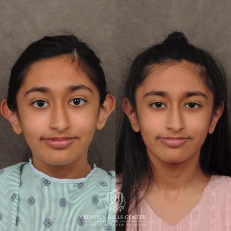 Beverly Hills Center Female Patient Before and After Otoplasty