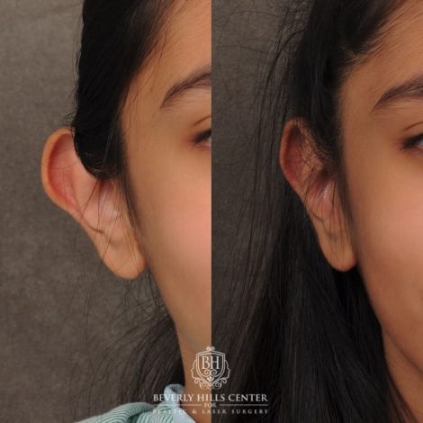 Beverly Hills Center Female Patient Before and After Otoplasty
