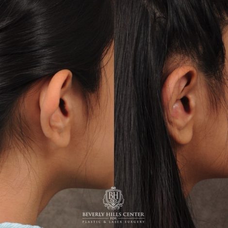 Beverly Hills Center Female Patient Before and After Otoplasty
