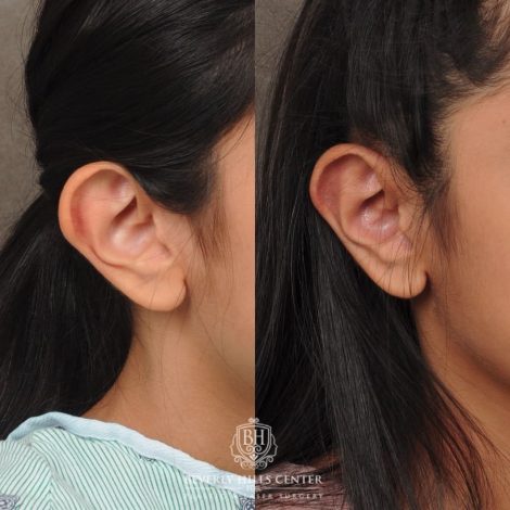 Beverly Hills Center Female Patient Before and After Otoplasty