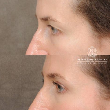 Beverly Hills Center Female Patient Before and After Upper Blepharoplasty