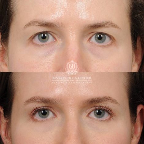 Beverly Hills Center Female Patient Before and After Upper Blepharoplasty