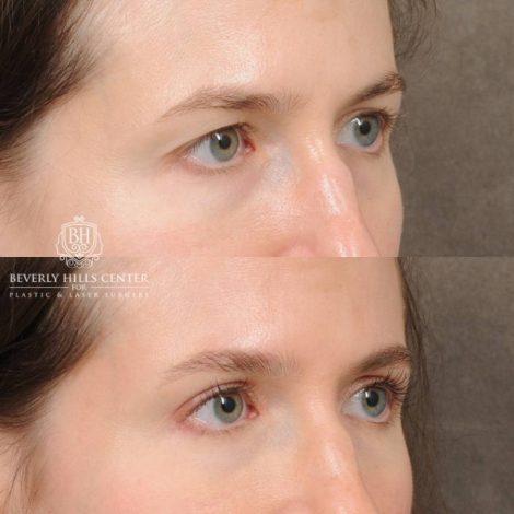 Beverly Hills Center Female Patient Before and After Upper Blepharoplasty
