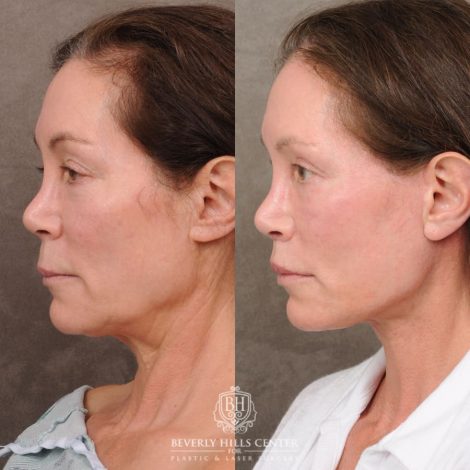 Beverly Hills Center Female Patient Before and After AuraLyft, Brow Lift, CUPID LIFT® Lip Lift, and Lower Eyelid Canthopexy