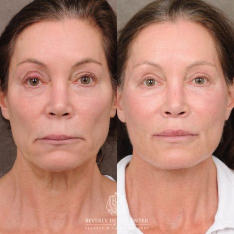 Beverly Hills Center Female Patient Before and After AuraLyft, Brow Lift, CUPID LIFT® Lip Lift, and Lower Eyelid Canthopexy