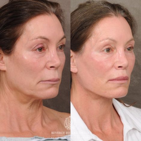 Beverly Hills Center Female Patient Before and After AuraLyft, Brow Lift, CUPID LIFT® Lip Lift, and Lower Eyelid Canthopexy