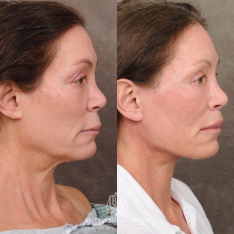 Beverly Hills Center Female Patient Before and After AuraLyft, Brow Lift, CUPID LIFT® Lip Lift, and Lower Eyelid Canthopexy