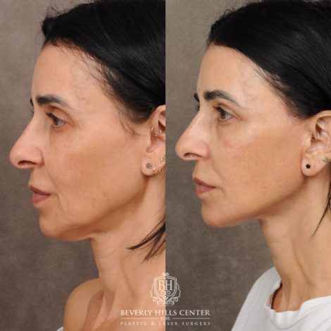 Beverly Hills Center Female Patient Before and After AuraLyft