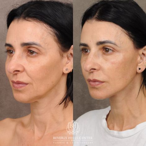 Beverly Hills Center Female Patient Before and After AuraLyft