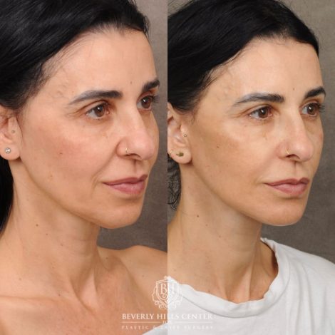 Beverly Hills Center Female Patient Before and After AuraLyft