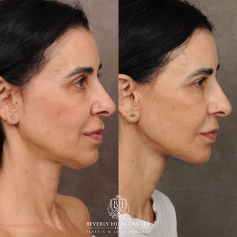 Beverly Hills Center Female Patient Before and After AuraLyft