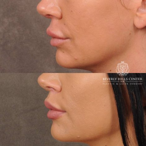 Beverly Hills Center Female Patient Before and After CUPID LIFT® With Corners