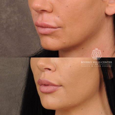 Beverly Hills Center Female Patient Before and After CUPID LIFT® With Corners