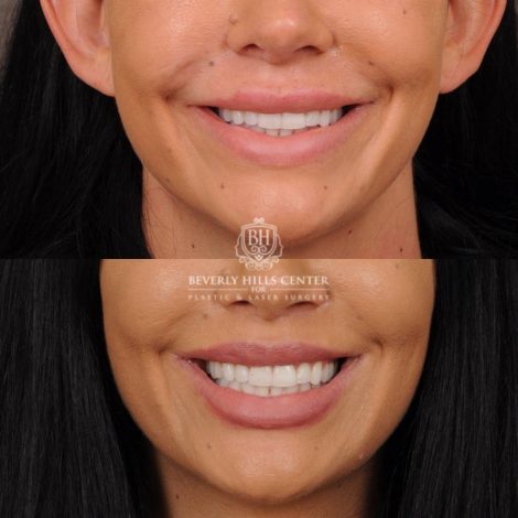 Beverly Hills Center Female Patient Before and After CUPID LIFT® With Corners