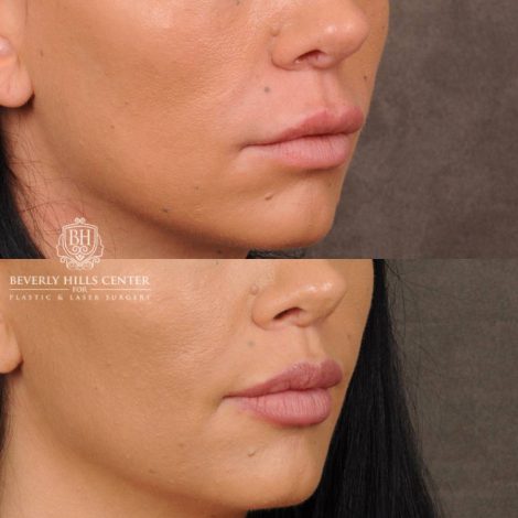 Beverly Hills Center Female Patient Before and After CUPID LIFT® With Corners