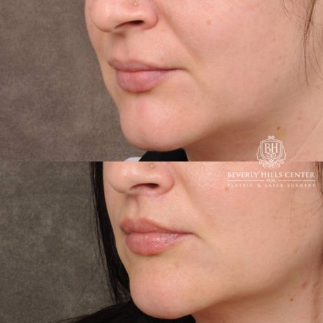 Beverly Hills Center Female Patient Before and After CUPID LIFT® Lip Lift