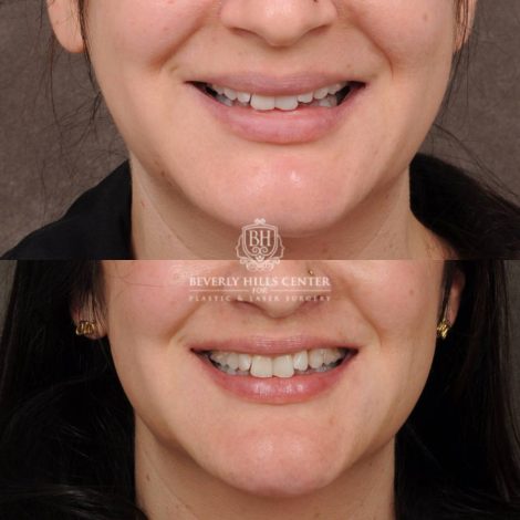 Beverly Hills Center Female Patient Before and After CUPID LIFT® Lip Lift