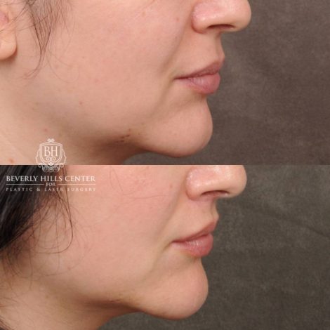 Beverly Hills Center Female Patient Before and After CUPID LIFT® Lip Lift